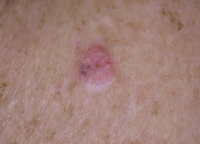 Summerland Skin Cancer Clinic | » Basal Cell Carcinoma