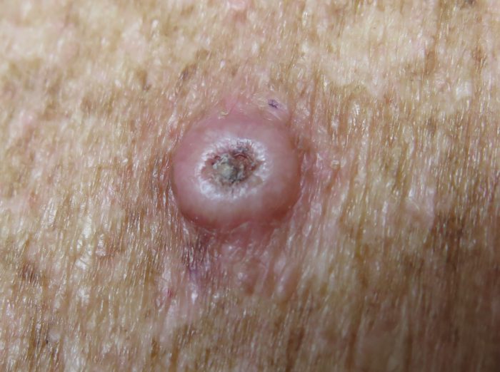 Summerland Skin Cancer Clinic | » Squamous Cell Carcinoma